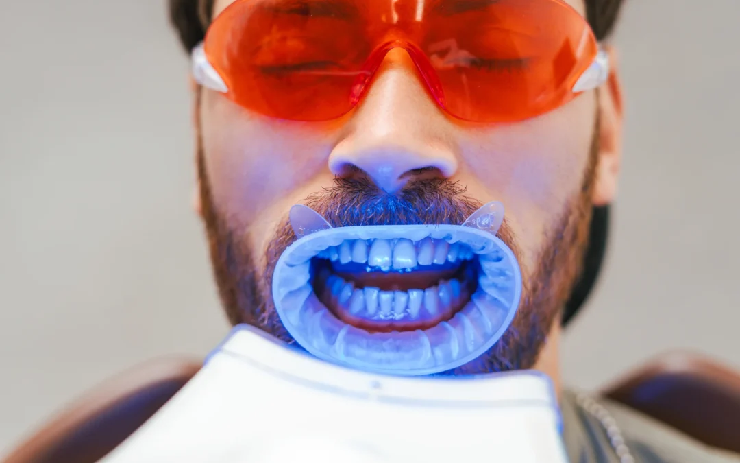 Sbiancamento dentale a Grottammare: come arrivare all’estate con un sorriso luminoso