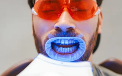 Sbiancamento dentale a Grottammare: come arrivare all’estate con un sorriso luminoso